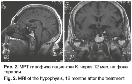 Рис. 2. МРТ гипофиза пациентки К. через 12 мес. на фоне терапии Fig. 2. MRI of the hypophysis, 12 months after the treatment