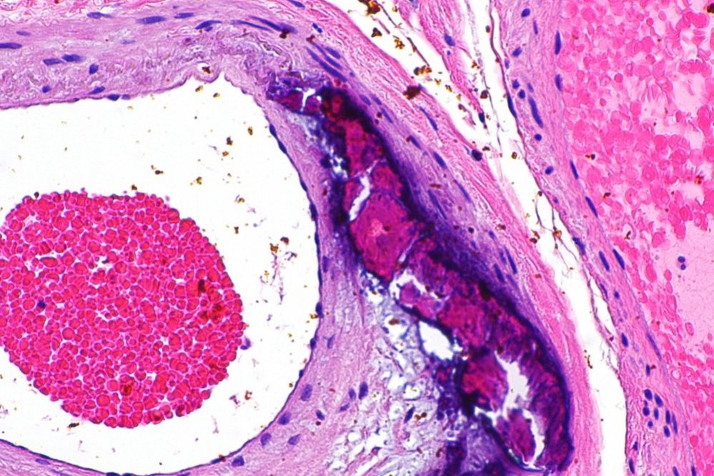 Инкретины связали с атеросклерозом — Медицина 2.0