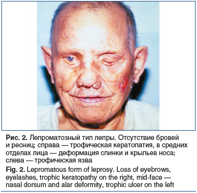 Рис. 2. Лепроматозный тип лепры. Отсутствие бровей и ресниц; справа — трофическая кератопатия, в средних отделах лица — деформация спинки и крыльев носа; слева — трофическая язва Fig. 2. Lepromatous form of leprosy. Loss of eyebrows, eyelashes, trophic ke