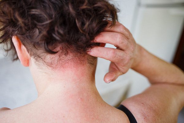 Кожные симптомы серьезных заболеваний, которые не стоит игнорировать