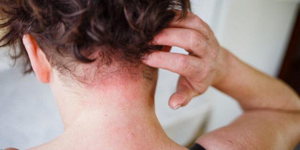 Кожные симптомы серьезных заболеваний, которые не стоит игнорировать