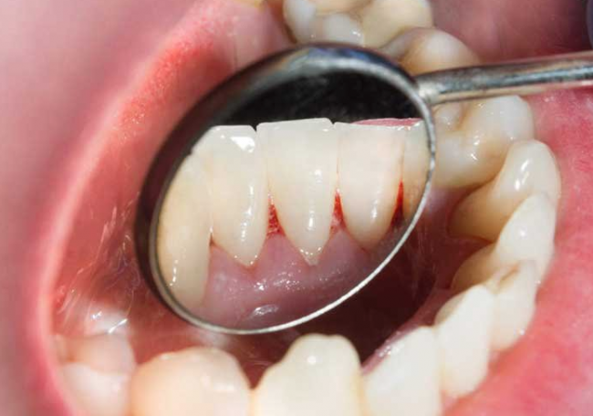 Российские ученые узнали, как победить пародонтит
