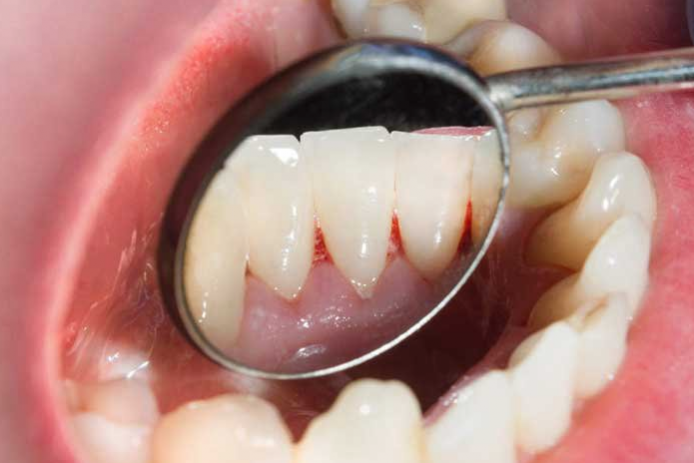 Российские ученые узнали, как победить пародонтит