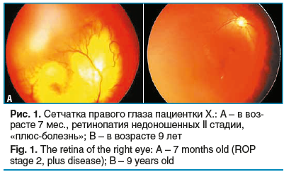 Рис. 1. Сетчатка правого глаза пациентки Х.: А – в воз- расте 7 мес., ретинопатия недоношенных II стадии, «плюс-болезнь»; В – в возрасте 9 лет Fig. 1. The retina of the right eye: A – 7 months old (ROP stage 2, plus disease); B – 9 years old