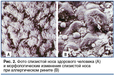 Рис. 2. Фото слизистой носа здорового человека (А) и морфологические изменения слизистой носа при аллергическом рините (В)