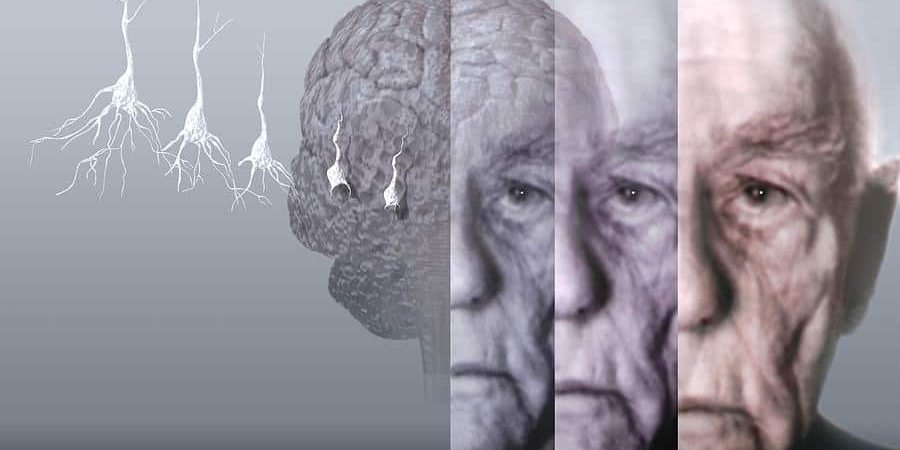 болезнь альцгеймера