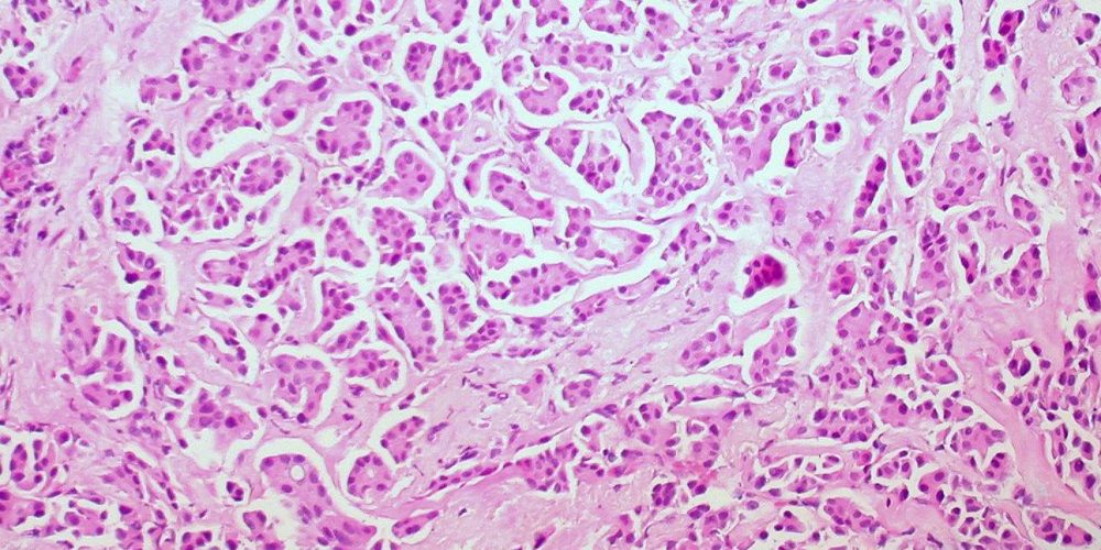 Андрогены могут помочь в лечении рака груди