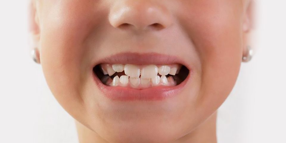 Исправить прикус возможно, вопрос в том, как именно это делать