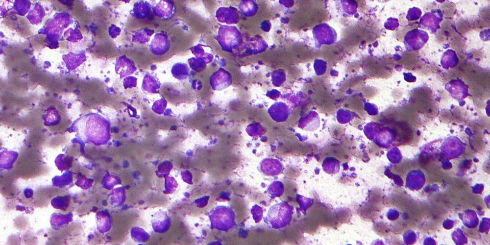 Недостаток холестерина убивает рака — Медицина 2.0