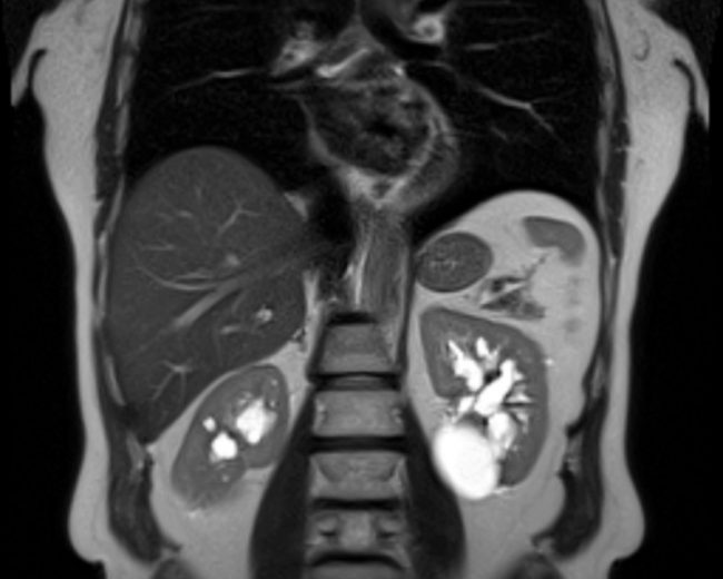 Мелатонин может помочь при поликистозе почек