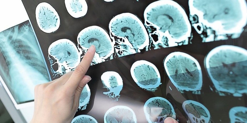 У пациентов с рассеянным склерозом появилась надежда в лице нового средства