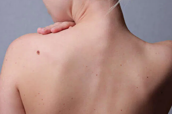Красные “родинки” на теле: о чем говорят новообразования