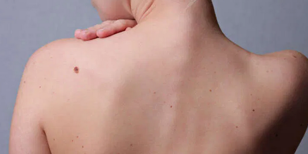 Красные “родинки” на теле: о чем говорят новообразования