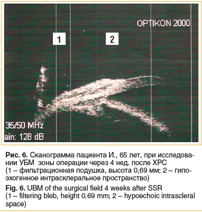 Рис. 6. Сканограмма пациента И., 65 лет, при исследова- нии УБМ зоны операции через 4 нед. после ХРС (1 – фильтрационная подушка, высота 0,69 мм; 2 – гипо- эхогенное интрасклеральное пространство) Fig. 6. UBM of the surgical field 4 weeks after SSR (1 – f