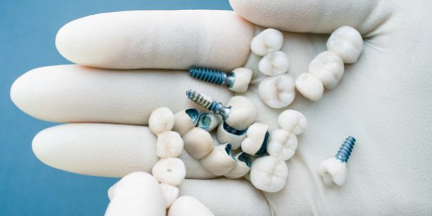 Что нельзя делать, если во рту стоят имплантаты