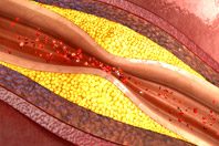 Исследователи разобрались в истинной природе развития атеросклероза