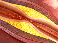 Исследователи разобрались в истинной природе развития атеросклероза