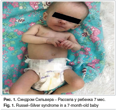 Рис. 1. Синдром Сильвера – Рассела у ребенка 7 мес. Fig. 1. Russel–Silver syndrome in a 7-month-old baby