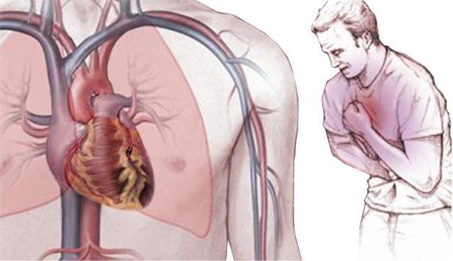 Кардиологи узнали, что на самом деле вызывает болезни сосудов