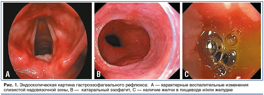 Рис. 1. Эндоскопическая картина гастроэзофагеального рефлюкса: А — характерные воспалительные изменения слизистой надсвязочной зоны, В — катаральный эзофагит, С — наличие желчи в пищеводе и/или желудке