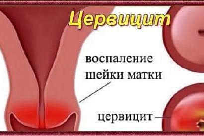 Cervicit-u-zhenshhin-min