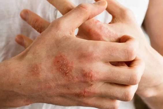 Аллергический дерматит: названы симптомы и способы лечения
