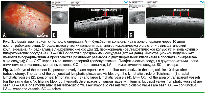 Рис. 3. Левый глаз пациентки К. после операции: А — бульбарная конъюнктива в зоне операции через 10 дней после трабекулотомии. Определяются участки конъюнктивального лимфатического сплетения: лимфатический круг Тейхмана (1), радиальные лимфатические сосуд