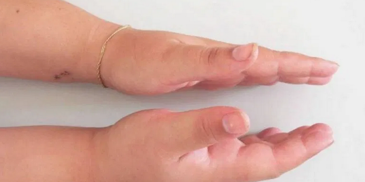 Отек Квинке: как распознать аллергическую реакцию, которая может закончиться смертью