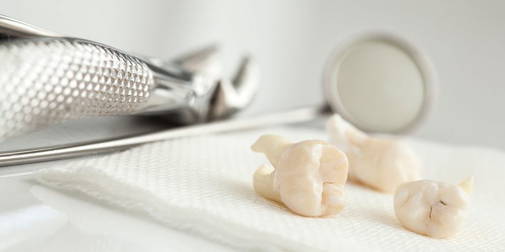 Удаление зубов мудрости может улучшить вкусовые ощущения