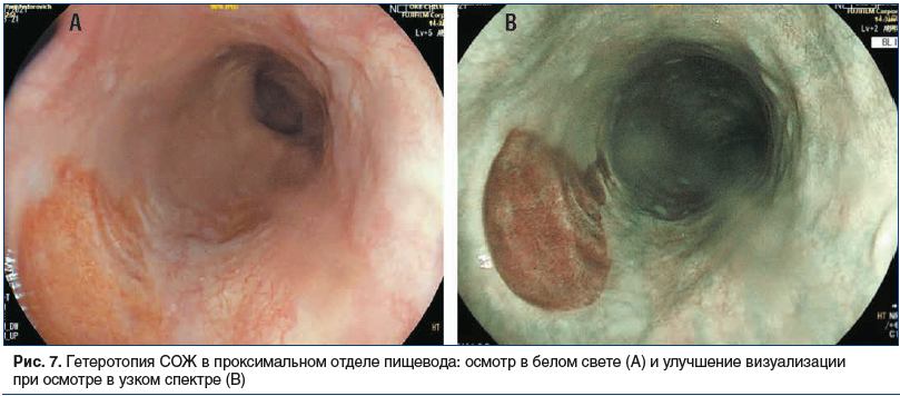 Рис. 7. Гетеротопия СОЖ в проксимальном отделе пищевода: осмотр в белом свете (А) и улучшение визуализации при осмотре в узком спектре (B)