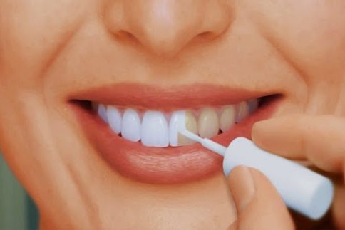 4 главных минуса отбеливания зубов