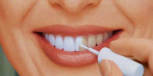 4 главных минуса отбеливания зубов