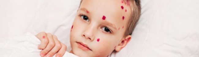 Роспотребнадзор предупреждает: заболеваемость ветрянкой снижается, риск остается