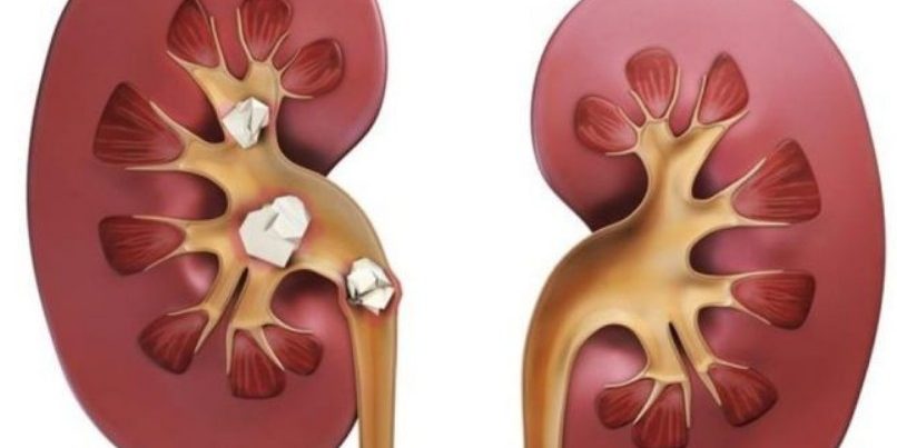 Камни в почках: избавление с помощью натурального домашнего сиропа