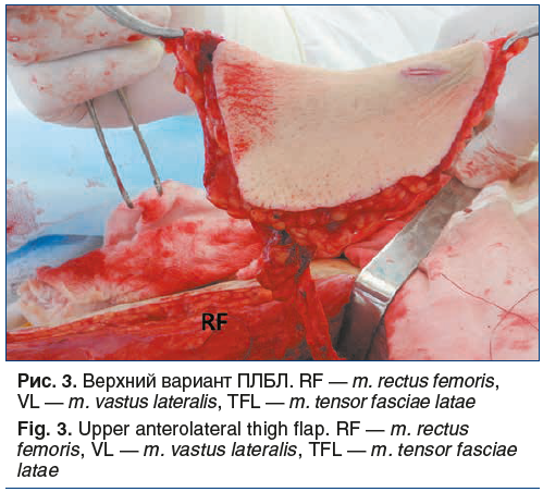 Рис. 3. Верхний вариант ПЛБЛ. RF — m. rectus femoris, VL — m. vastus lateralis, TFL — m. tensor fasciae latae Fig. 3. Upper anterolateral thigh flap. RF — m. rectus femoris, VL — m. vastus lateralis, TFL — m. tensor fasciae latae