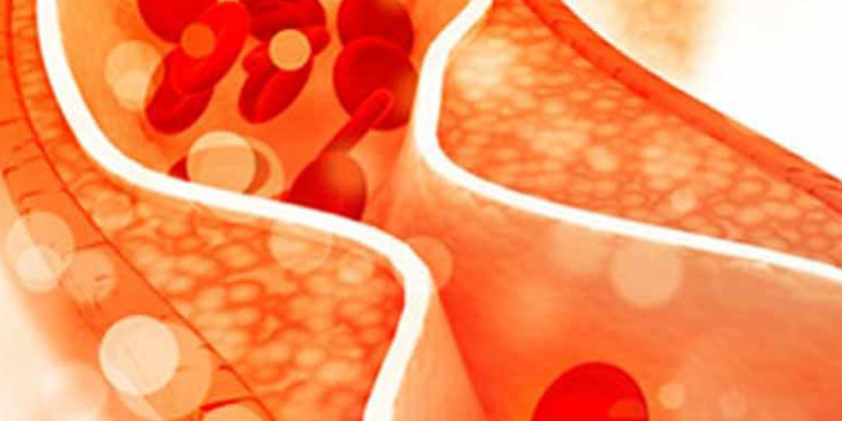 Медики из США рассказали, какие виды боли указывают на повышенный «плохой» холестерин