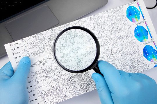 Риск эпилепсии резко возрастает через год после перенесенного инсульта