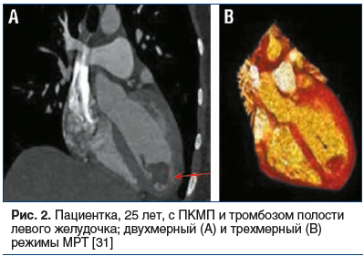 Рис. 2. Пациентка, 25 лет, с ПКМП и тромбозом полости левого желудочка; двухмерный (A) и трехмерный (B) режимы МРТ [31]