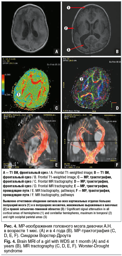 Рис. 4. МР-изображения головного мозга девочки А.Н. в возрасте 1 мес. (А) и в 4 года (B). МР-трактография (C, D, E, F). Синдром Ворстер-Дроута Fig. 4. Brain MRI of a girl with WDS at 1 month (A) and 4 years (B). MR tractography (C, D, E, F). Worster-Droug