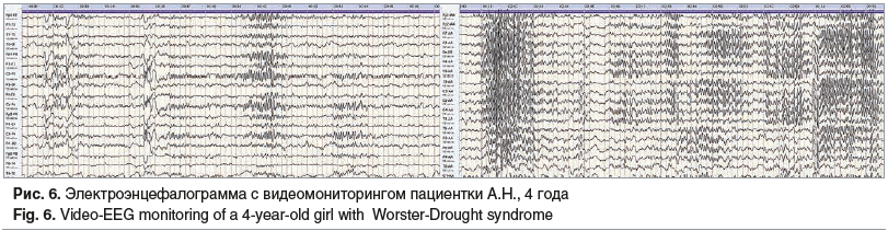 Рис. 6. Электроэнцефалограмма с видеомониторингом пациентки А.Н., 4 года Fig. 6. Video-EEG monitoring of a 4-year-old girl with Worster-Drought syndrome