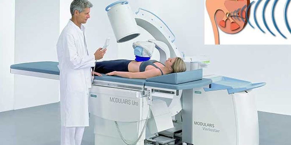 Ультразвук может заранее разбить камни в почках