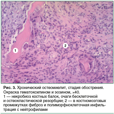 Рис. 3. Хронический остеомиелит, стадия обострения. Окраска гематоксилином и эозином, ×40. 1 — некробиоз костных балок, очаги бесклеточной и остеокластической резорбции; 2 — в костномозговых промежутках фиброз и полиморфноклеточная инфиль- трация с нейтро