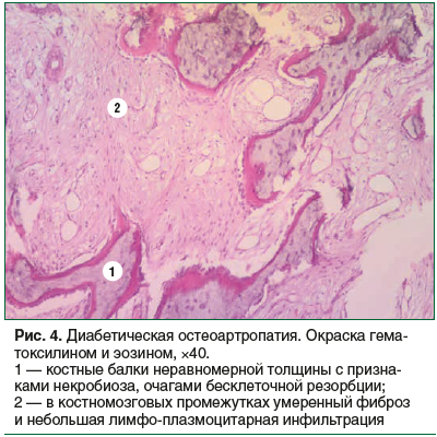 Рис. 4. Диабетическая остеоартропатия. Окраска гема- токсилином и эозином, ×40. 1 — костные балки неравномерной толщины с призна- ками некробиоза, очагами бесклеточной резорбции; 2 — в костномозговых промежутках умеренный фиброз и небольшая лимфо-плазмоци