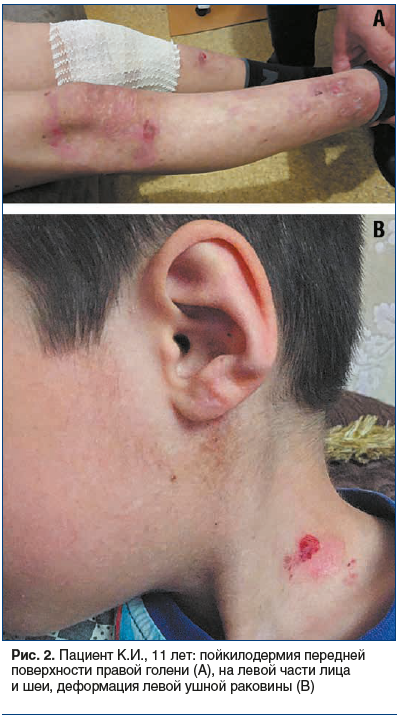 Рис. 2. Пациент К.И., 11 лет: пойкилодермия передней поверхности правой голени (А), на левой части лица и шеи, деформация левой ушной раковины (B)