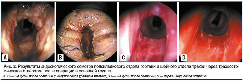 Рис. 2. Результаты эндоскопического осмотра подскладкового отдела гортани и шейного отдела трахеи через трахеосто- мическое отверстие после операции в основной группе.