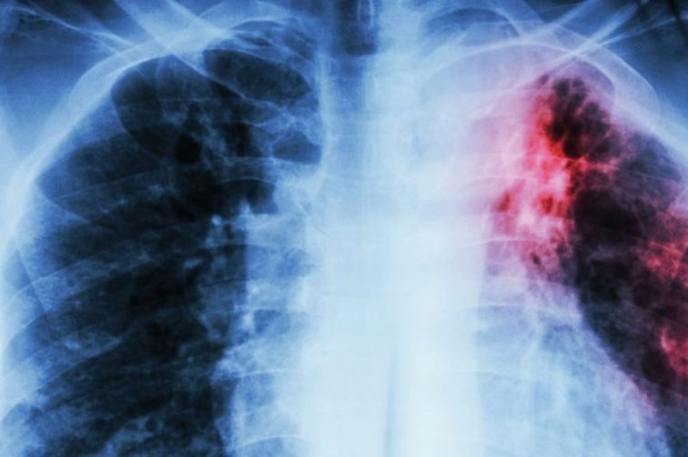 Небольшие генетические различия при туберкулезе приводят к очень разным заболеваниям