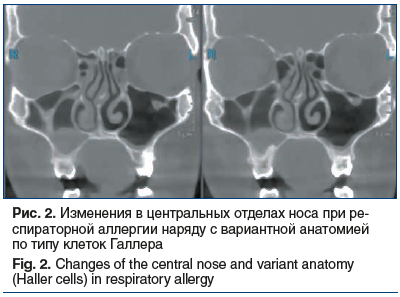 Рис. 2. Изменения в центральных отделах носа при ре- спираторной аллергии наряду с вариантной анатомией по типу клеток Галлера Fig. 2. Changes of the central nose and variant anatomy (Haller cells) in respiratory allergy
