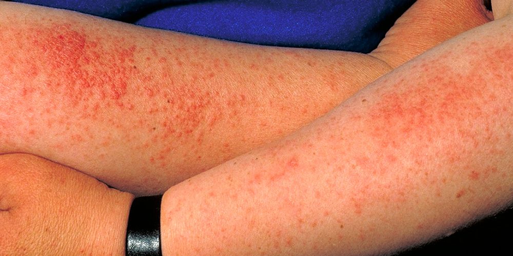 Дерматолог Сулима рассказала, из-за каких болезней может появиться аллергия на солнце