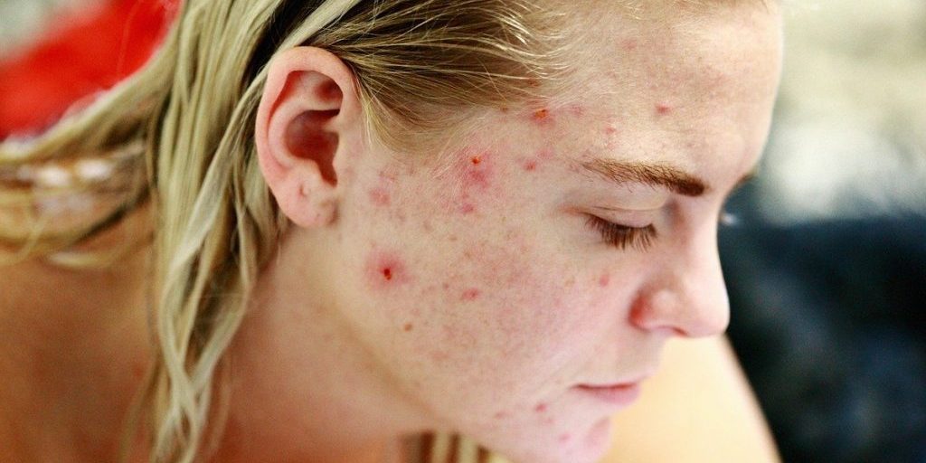 Дерматолог рассказала, почему нельзя давить прыщи