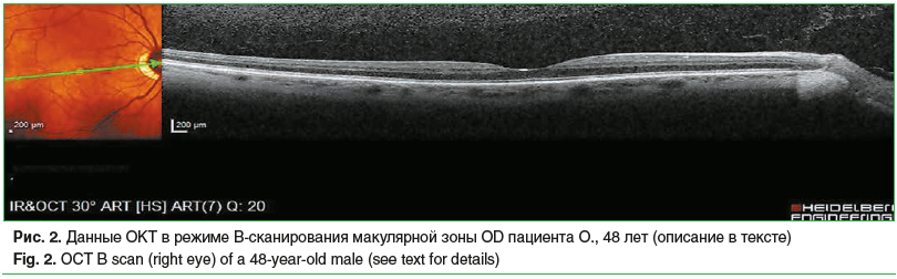 Рис. 2. Данные ОКТ в режиме B-cканирования макулярной зоны OD пациента О., 48 лет (описание в тексте) Fig. 2. OCT B scan (right eye) of a 48-year-old male (see text for details)